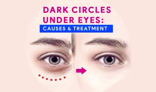How to Treat Dark Circles Under Your Eyes: Causes, Tips &amp; Top Product Picks