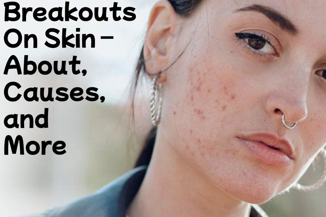 What Causes Breakouts &amp; How to Prevent Them
