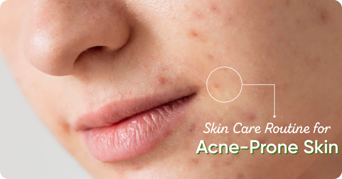 The Best Skincare Routine for Acne-Prone Skin: Simple and Effective Tips