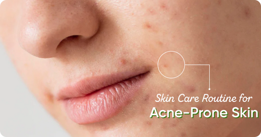 The Best Skincare Routine for Acne-Prone Skin: Simple and Effective Tips