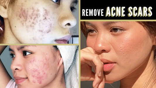 Top 5 Ingredients to Fade Acne Scars Fast.