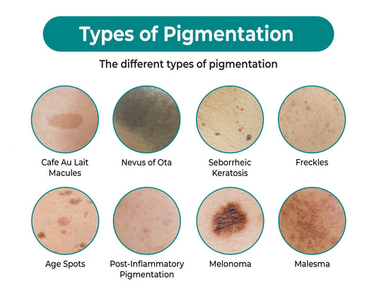 Understanding Skin Pigmentation: Causes, Prevention, and Solutions